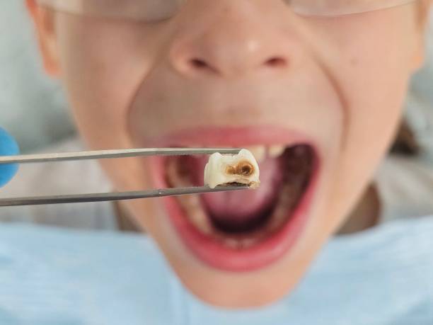 Best Emergency Dental Filling Replacement  in Barberton, WA