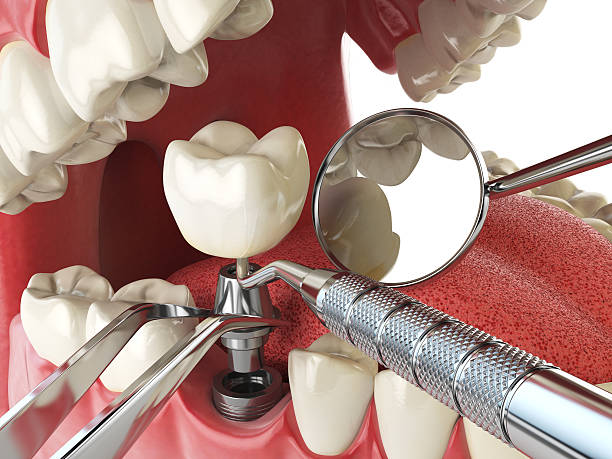 Best Knocked-Out Tooth Emergency  in Barberton, WA